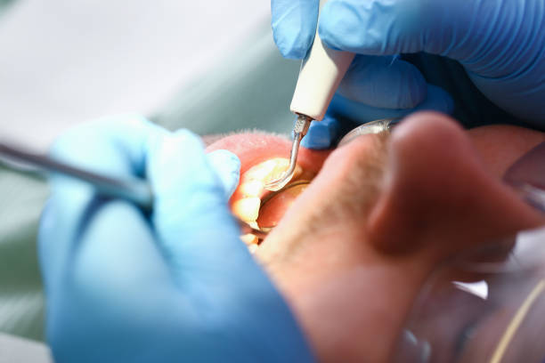 Best Dentist for Tooth Abscess  in Camp Barrett, VA